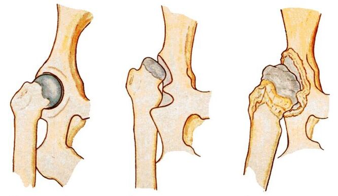 Hip dysplasia is a cause of secondary coxarthrosis