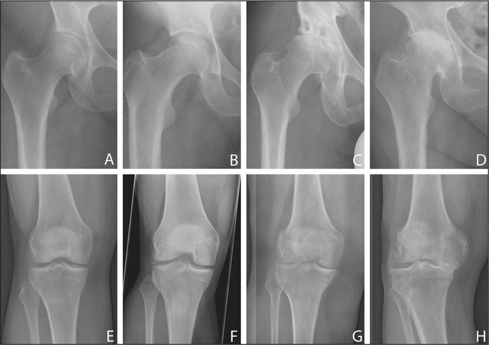 Osteoarthritis of the hip joint in dynamics