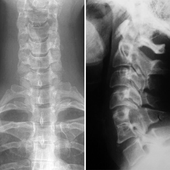 X -Araggio of the cervical column