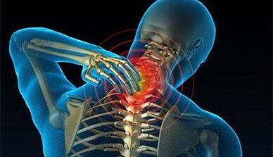 Symptoms of osteochondosis of the cervical column