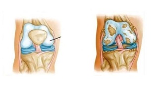 pathological changes in knee arthrosis