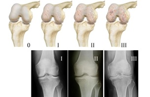 methods for diagnosing osteoarthritis of the knee