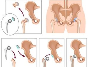 arthroplasty for osteoarthritis of the hip joint