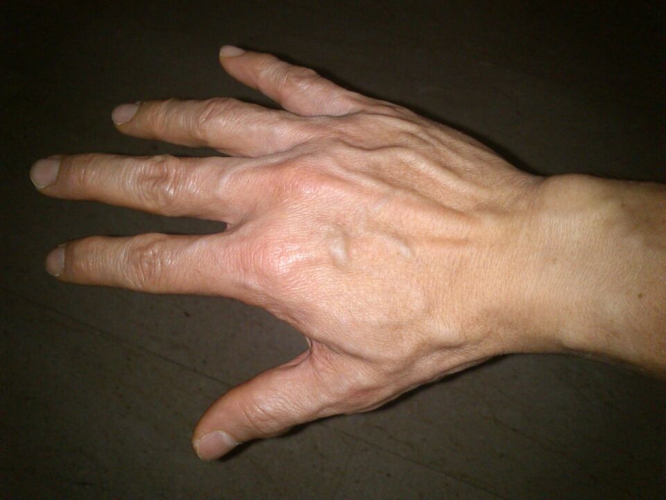 deformation of the bones and pain in the joints of the fingers